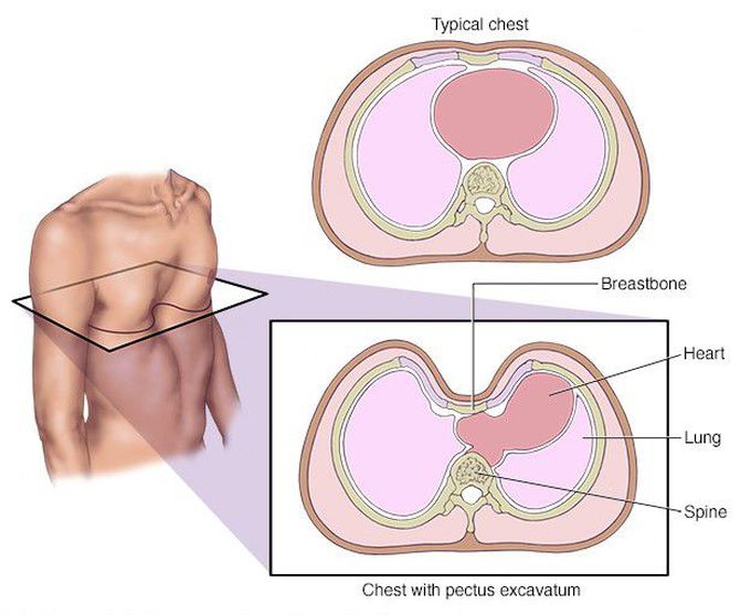 Pectus Excavatum - MEDizzy