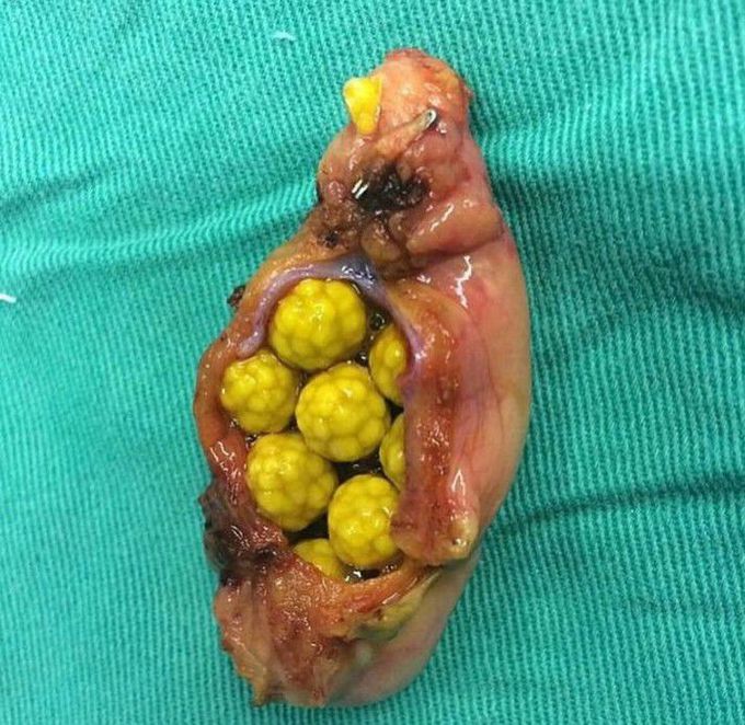 Cholesterol gall stones