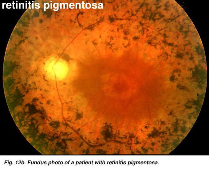 Retinosis pigmentaría