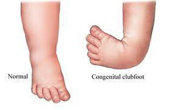 Congenital Talipes Equinovarus