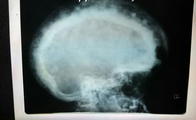 X-ray