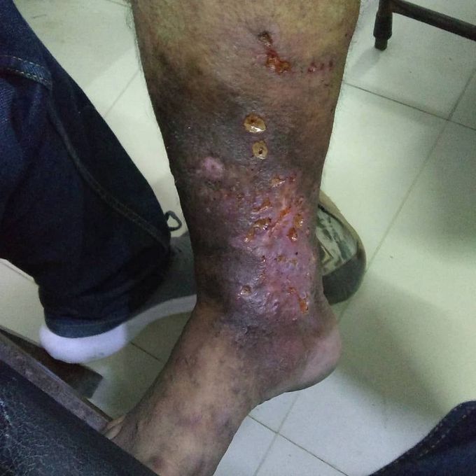 Eczema stasis