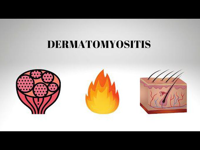 Pathology of Dermatomyositis.