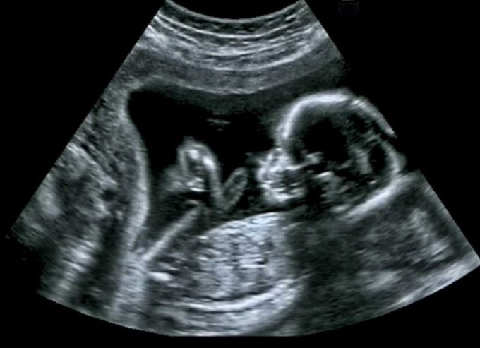 Indications of Ultrasound