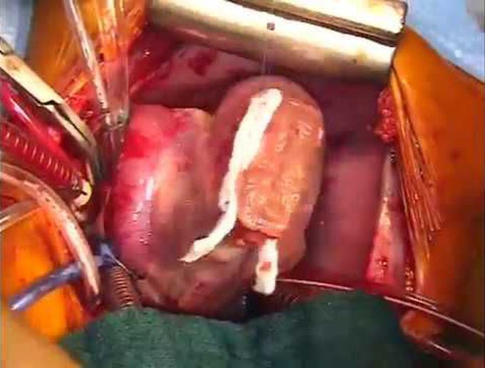 Surgical Repair of Cantrell’s Pentalogy With a Left Ventricular Diverticulum