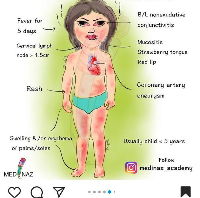 Kawasaki disease