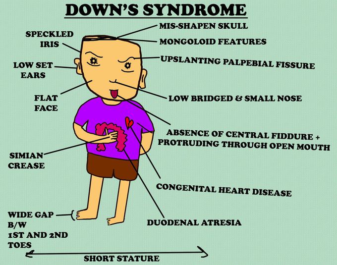 Downs syndrome