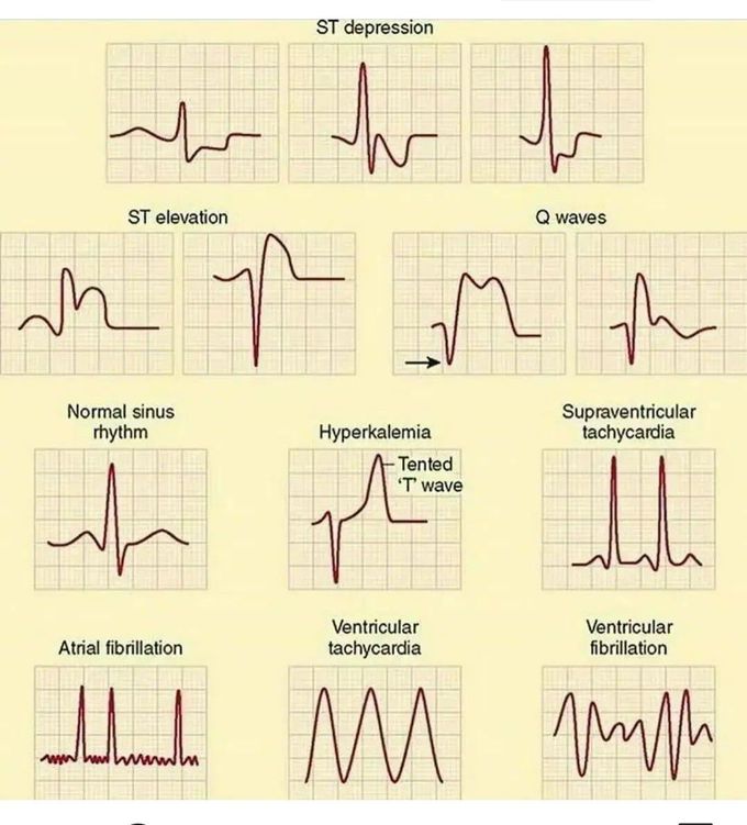 abnormal-heart-rhythms-medizzy