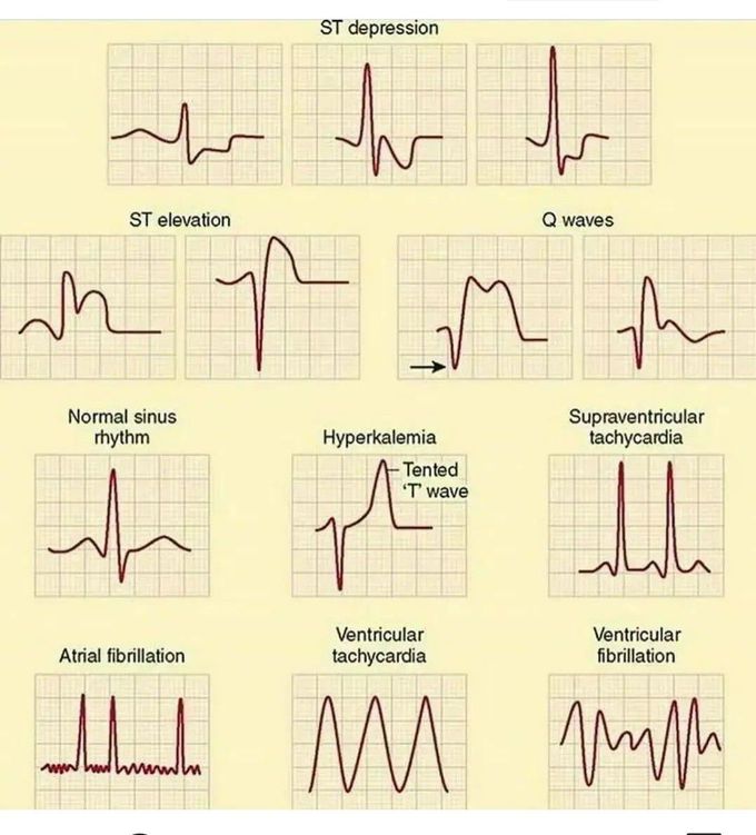 Abnormal Heart Rhythms