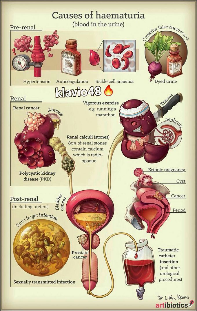 Causes For Hematuria