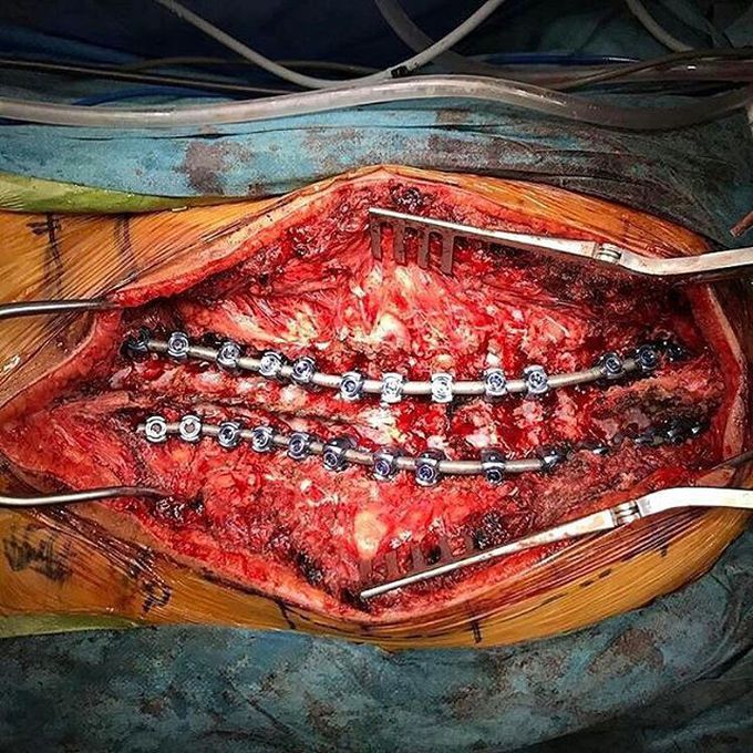 Intraoperative view of scoliosis surgery. 