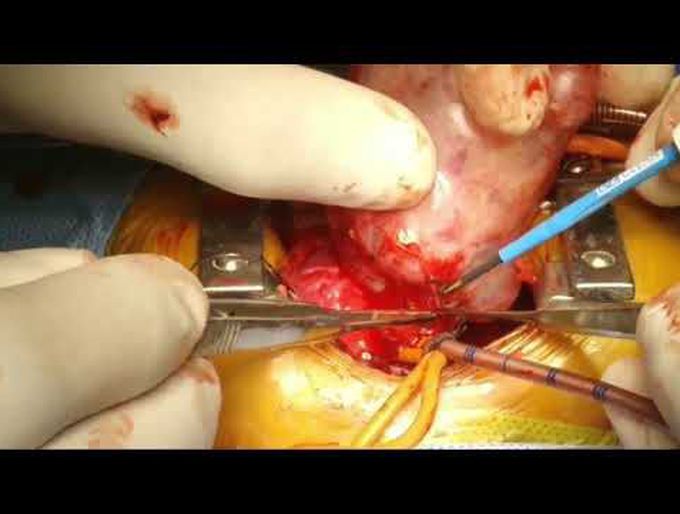 Neonatal Intrapericardial Teratoma Excision