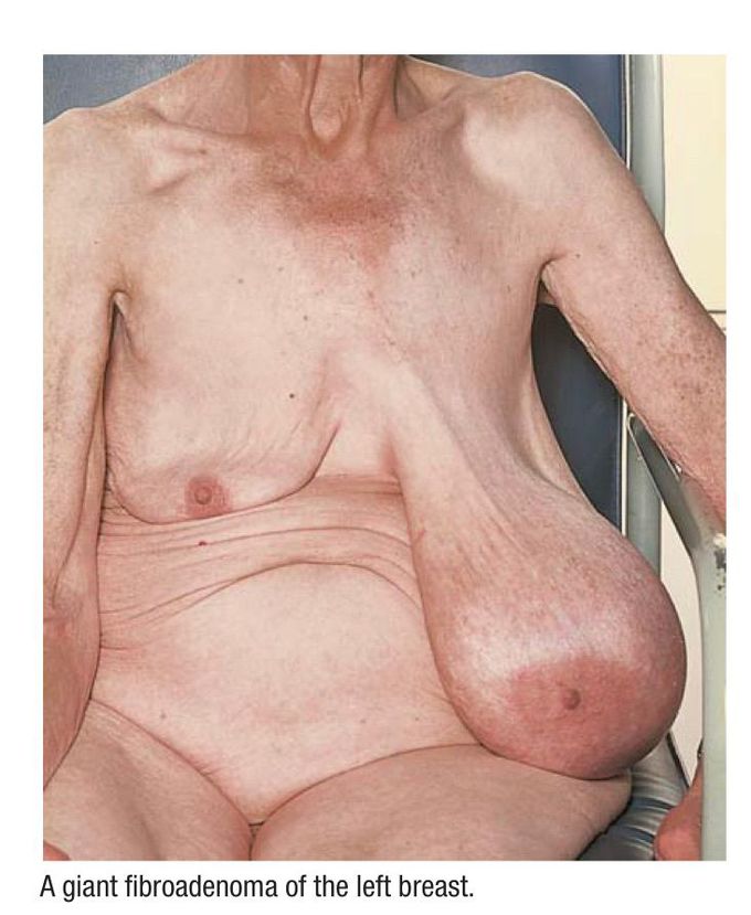 Breast Tumour