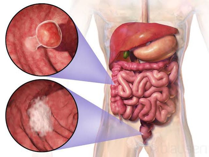 Bowel cancer