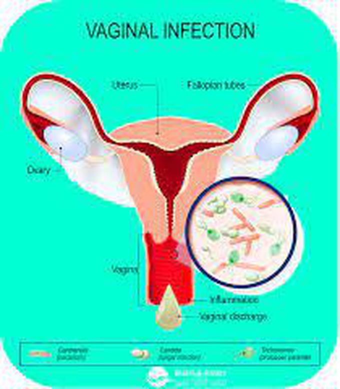 What are the symptoms of bacterial vaginosis?