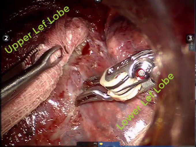 Robot-Assisted Left Upper Lobectomy After Immunotherapy