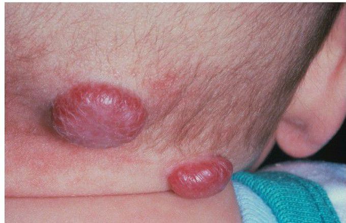 Hemangioma