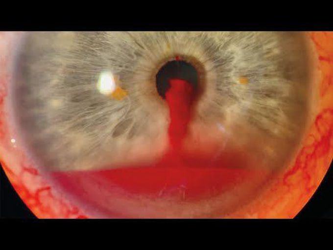Spontaneous Hyphema and Slit-Lamp Biomicroscopy.