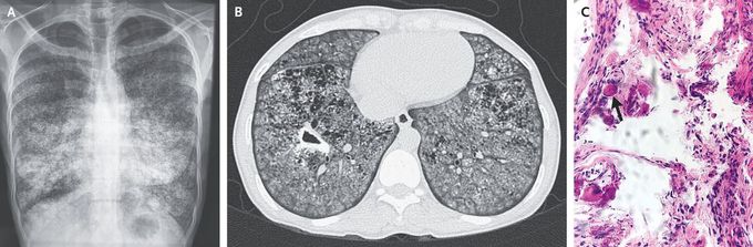 Pulmonary Alveolar Microlithiasis Complicated by Tuberculosis