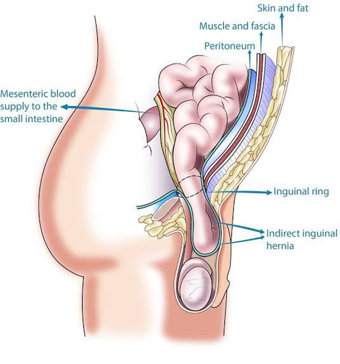 Indirect Inguinal Hernia