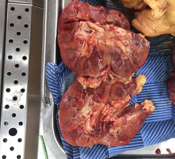 Kidney