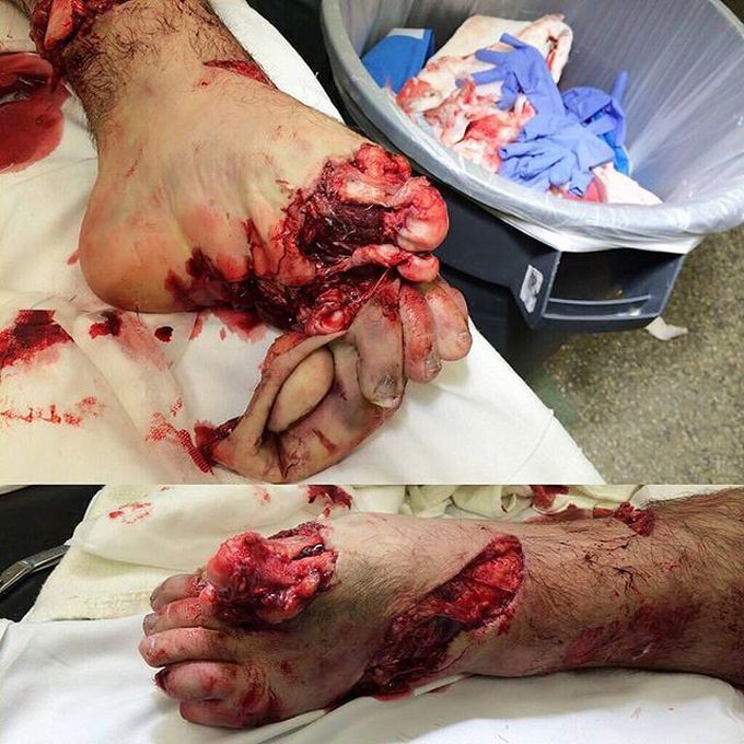 Boat propeller accident! 