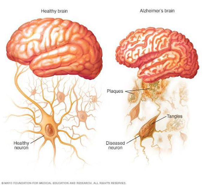 symptoms of alzheimer's disease
