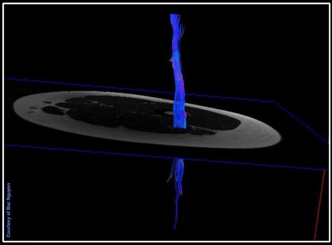 Diffusion Tensor Imaging