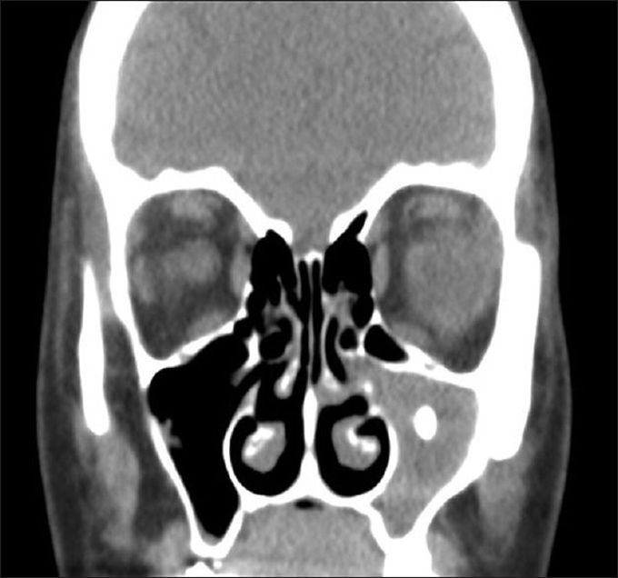 TOOTH IN MAXILLARY SINUS!!