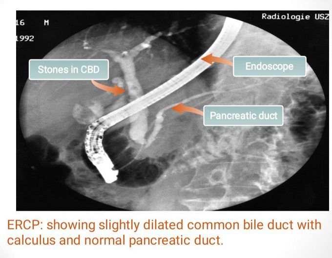 ERCP Results