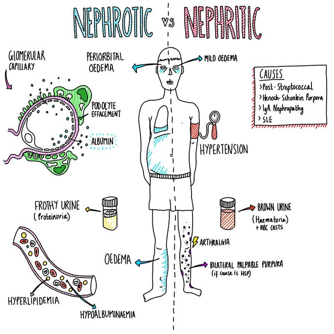 Nephrotic vs Nephritic