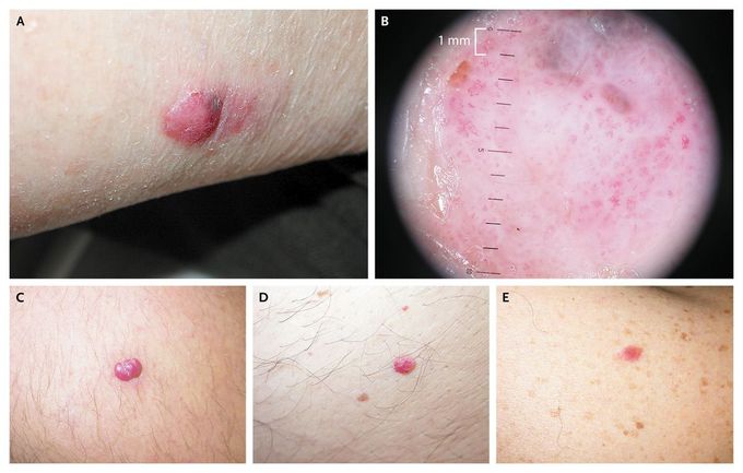 amelanotic melanoma