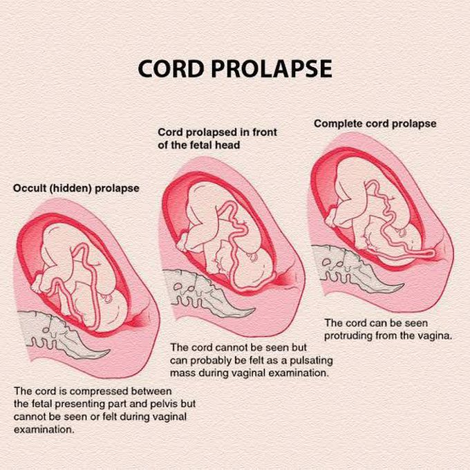 Key Aspects of Cord Prolapse