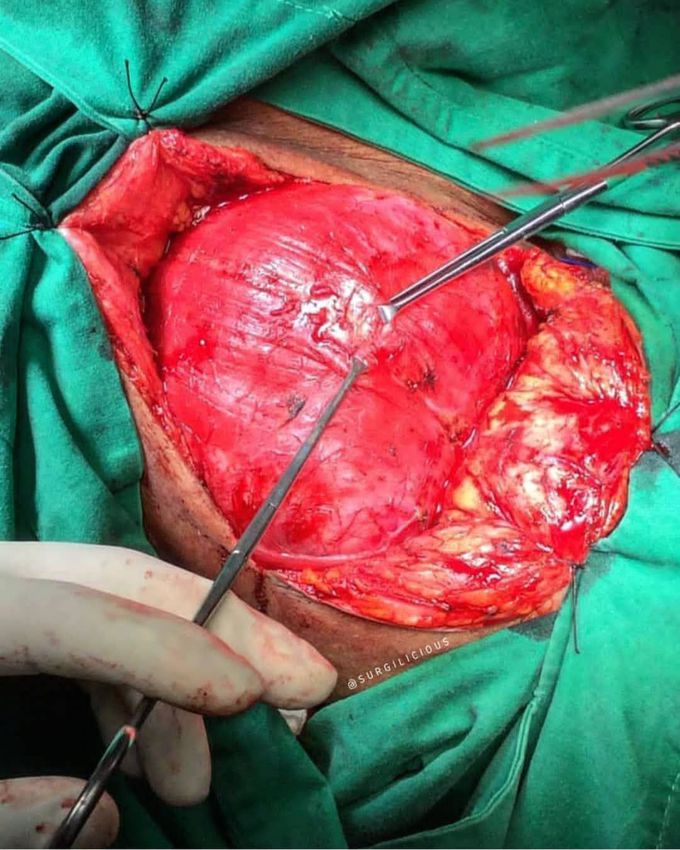 Platysma flap