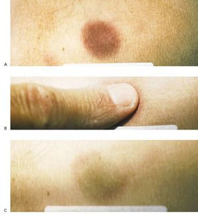 Chloroma