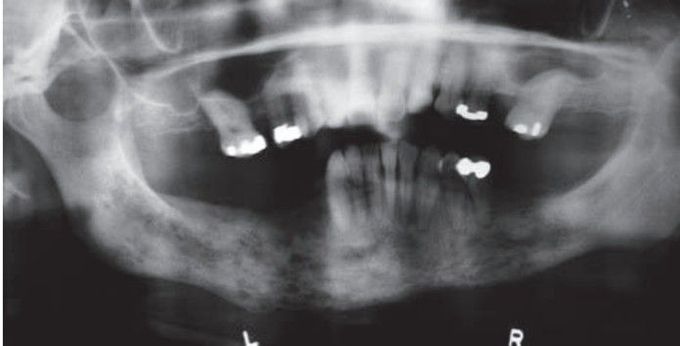 Chronic osteomyelitis