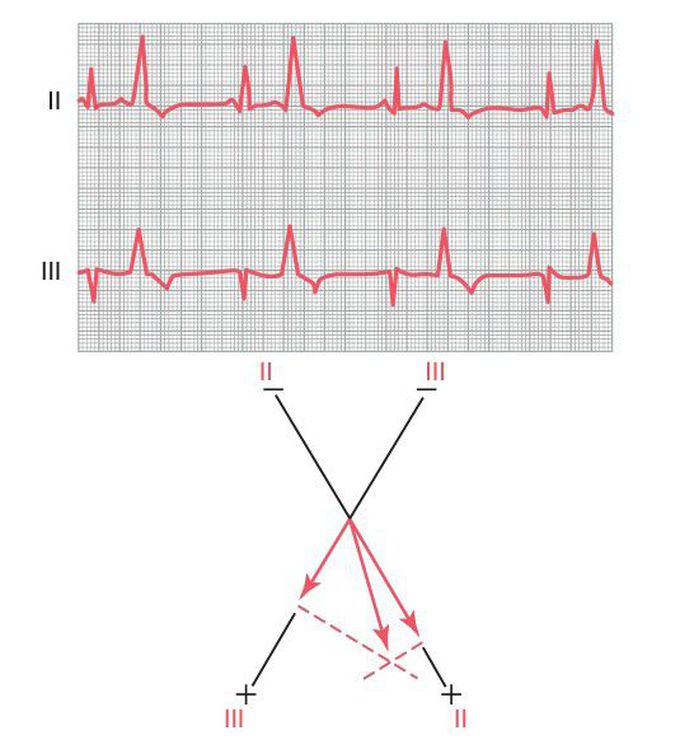 Ventricular contractions