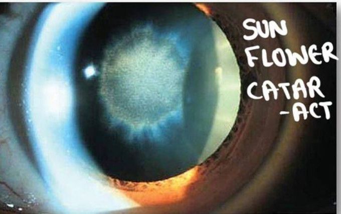 Sunflower-Shaped Cataract