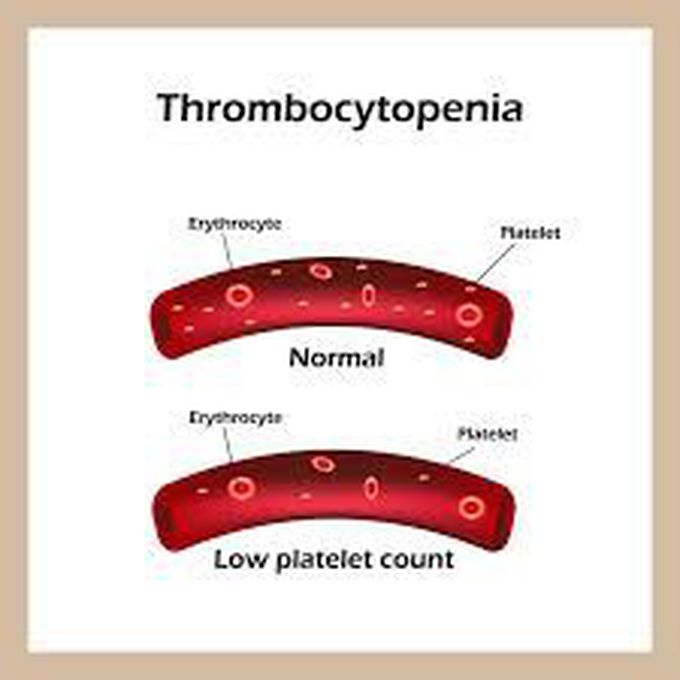 Thrombocytopenia