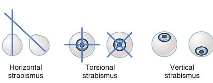 Strabismus