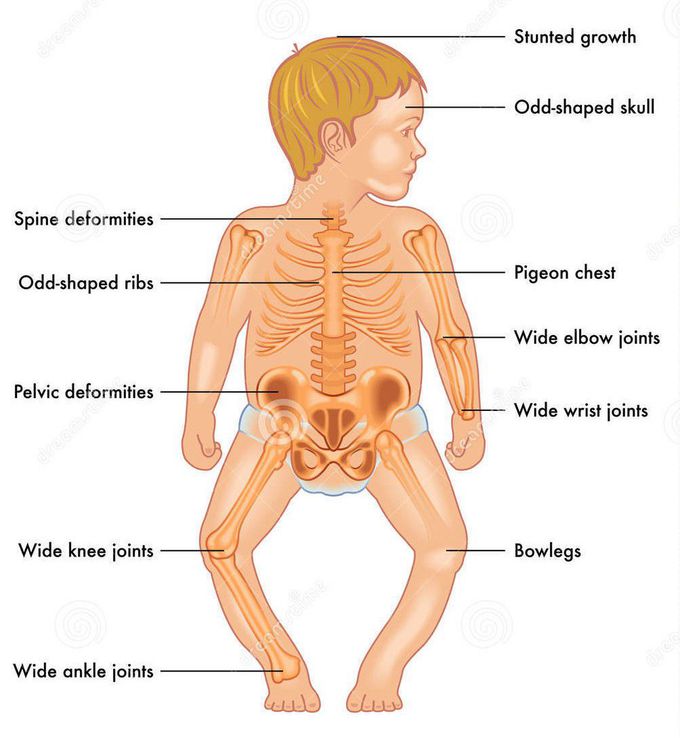 Common Signs of Rickets