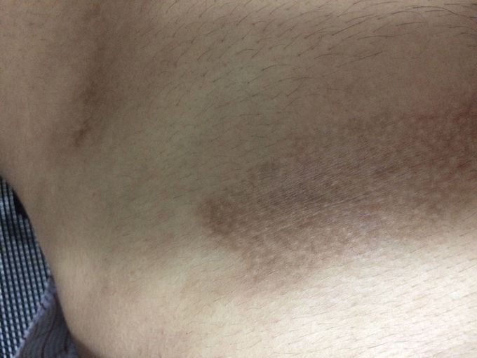 Skin problem