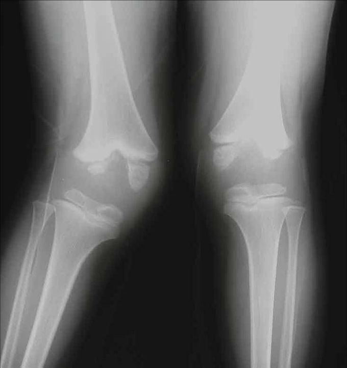 Hemophilic Arthropathy