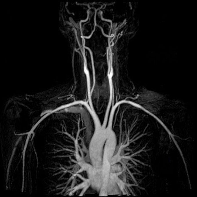 MR angiography of the chest!