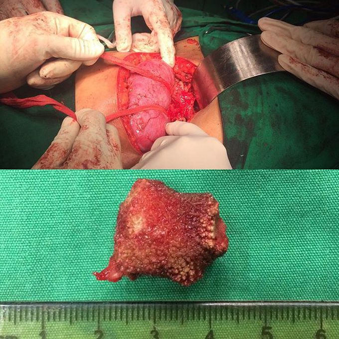 Rolled gauze