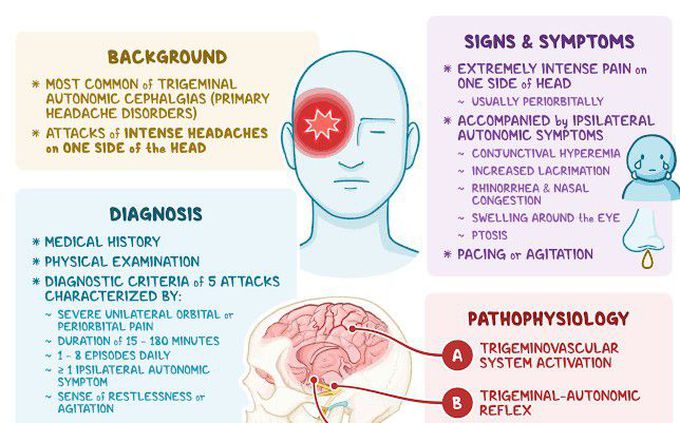 cluster headache