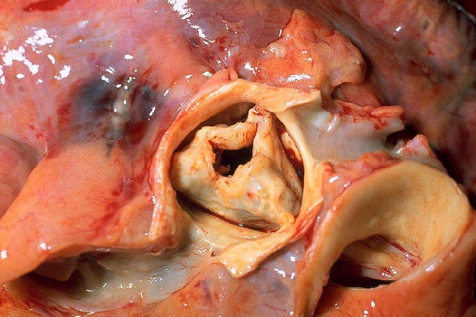 Aortic stenosis