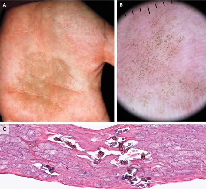 SciELO - Brasil - Tinea nigra: successful treatment with topical butenafine Tinea  nigra: successful treatment with topical butenafine