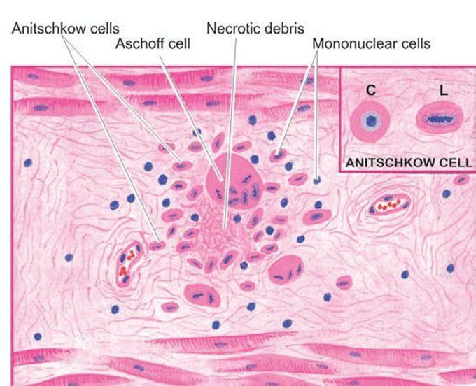 Aschoff body