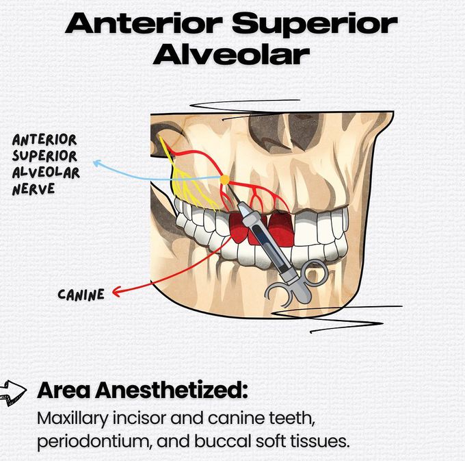 Maxillary Local Anesthesia VII